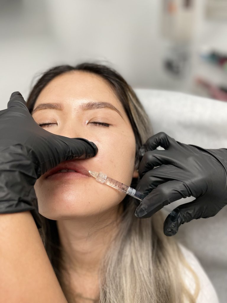 lip-flip-filler-dallas