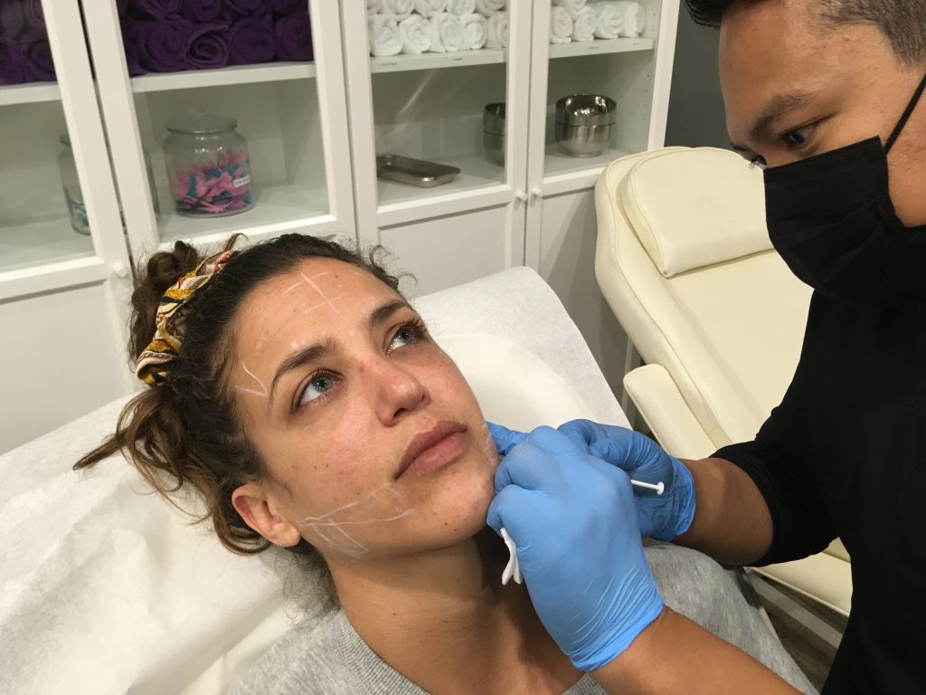 lip-flip-filler-orange-county